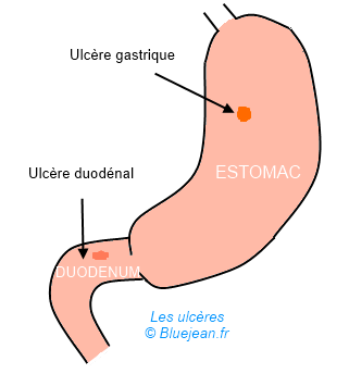 Ulcère de l'estomac et duodénal